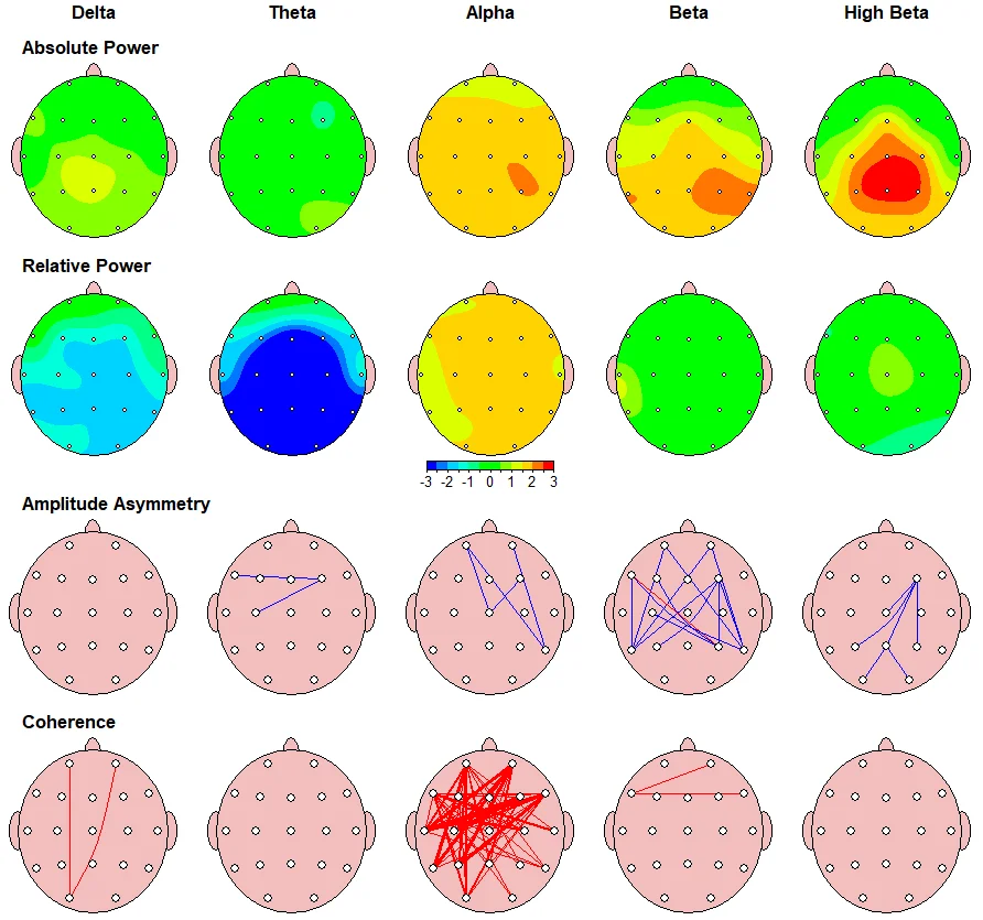 Brainmap QEEG Neurofeedback for Anxiety Treatment